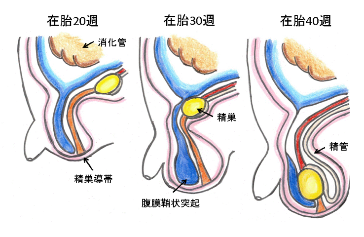 鼠経ヘルニア図1