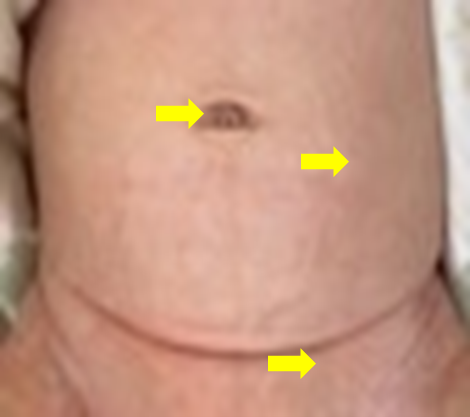 鼠経ヘルニア図3