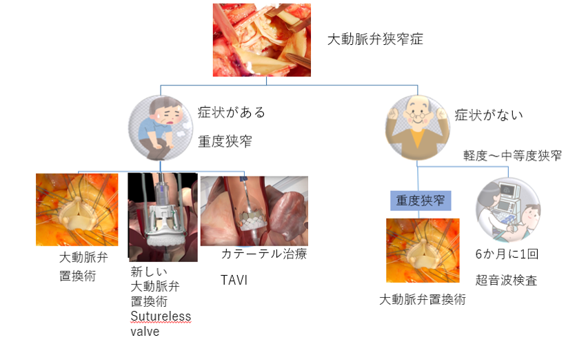 大動脈弁狭窄症