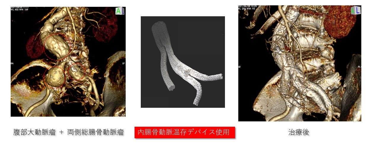 腹部・胸部ステントグラフト①