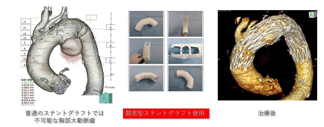 腹部・胸部ステントグラフト②