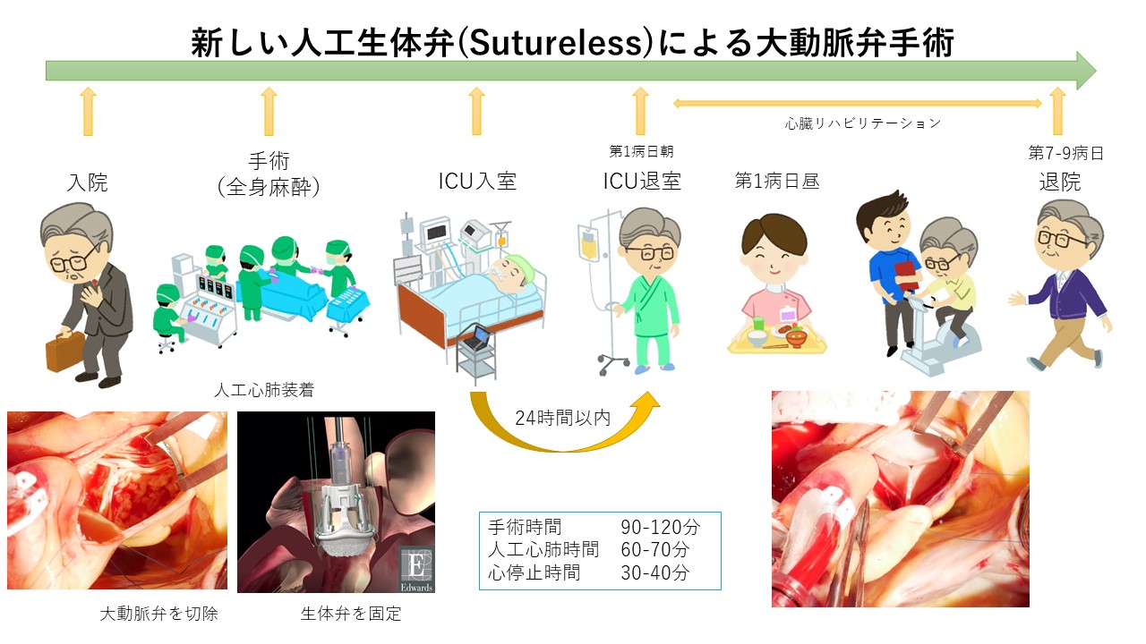 新しい人工生体弁(Sutureless)による大動脈弁手術